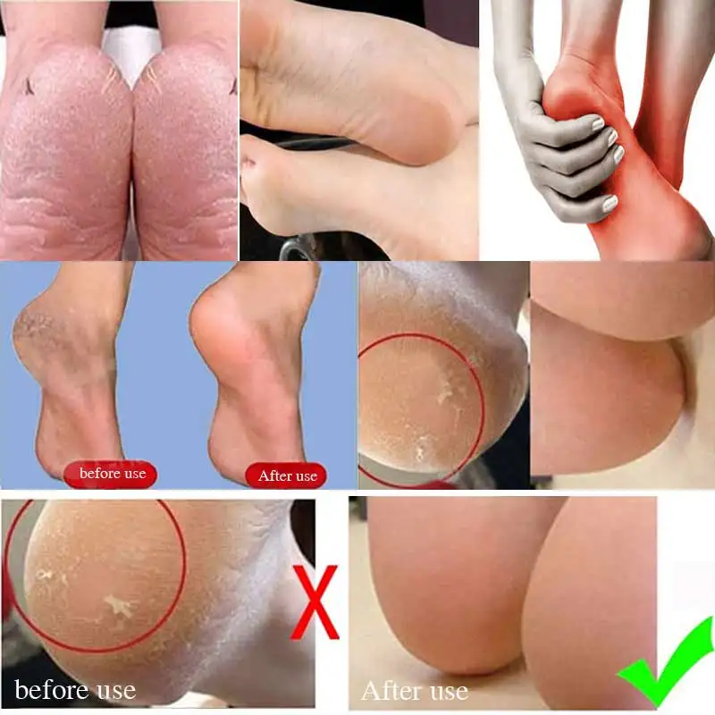 

5Pair Silicone Insole Socks Pedicure Foot Care Cracked Moisturizing Back Heel Skin Orthopedic Hallux Valgus Insoles Pedicura