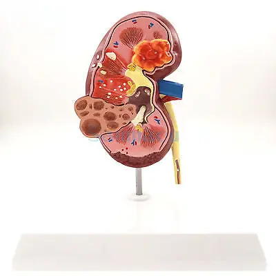 Модель болезненной почки человеческий анатомический медицинский образец
