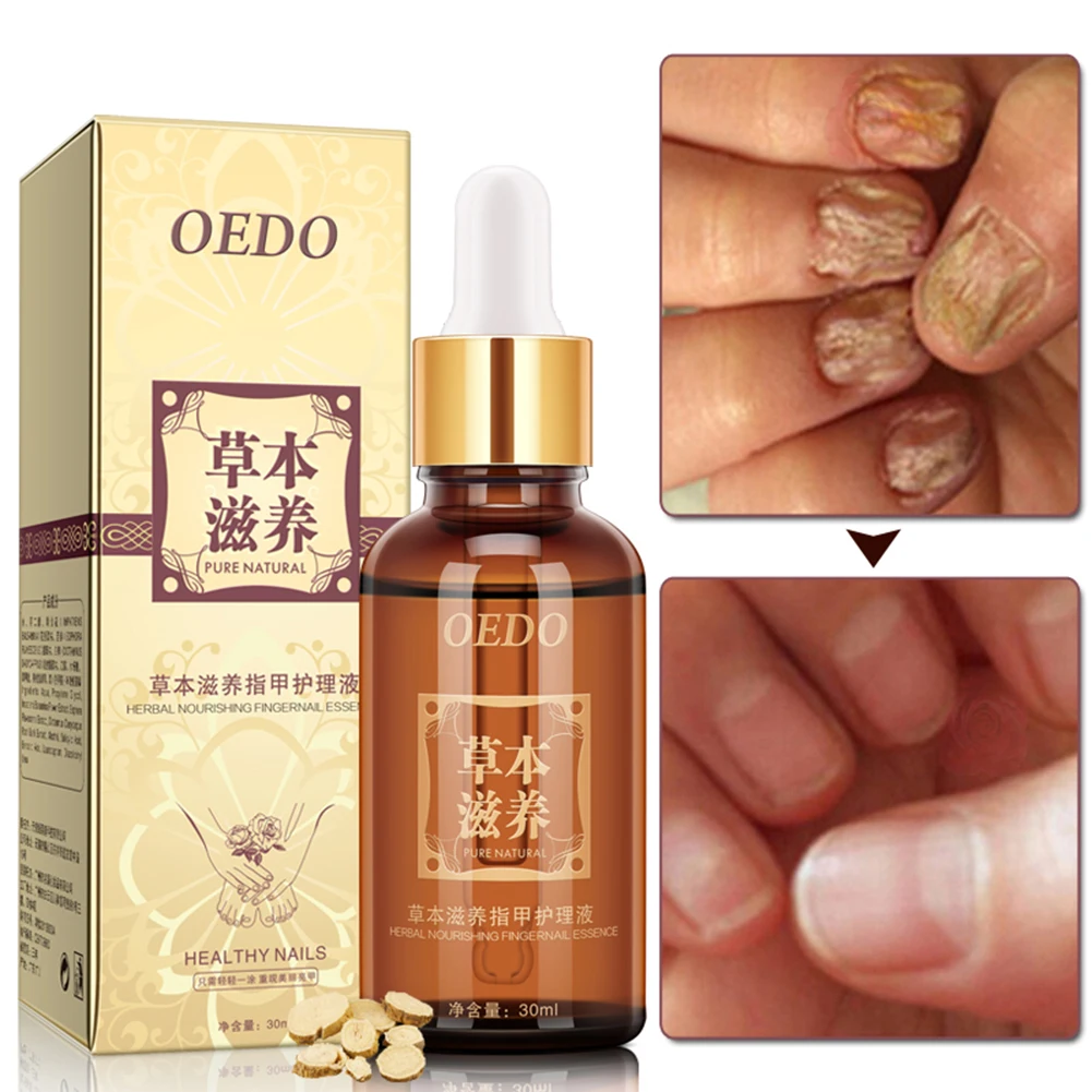 OEDO Herbal Fungal Nail Treatment Essential oil Hand and Foot Whitening Toe Nail Fungus Removal Infection Feet Care TSLM2