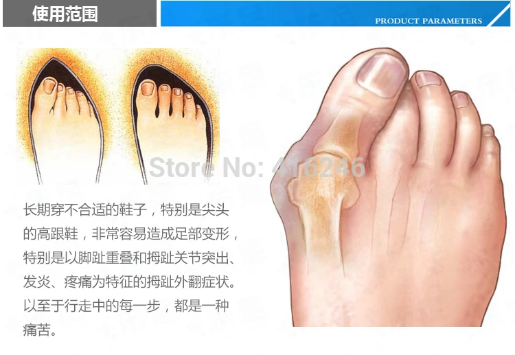 Genuine new special hallux valgus bicyclic thumb orthopedic braces to correct daily silicone toe big bone 5pair | Красота и здоровье