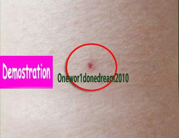 Эффект здоровья натуральный крот Nevus Wart метка на коже удаление Настоящее кожи Demo++ действительно работает