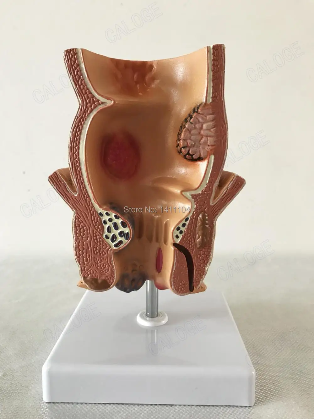 

Free shipping&Rectal pathological model,Ulcerative colitis,Hemorrhoids demonstration model,Teaching for medical