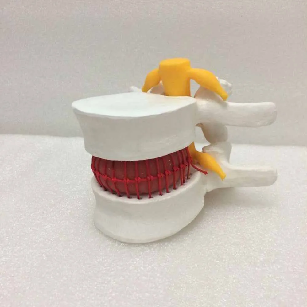 Позвоночник с проласным диском человеческая анатомическая модель |