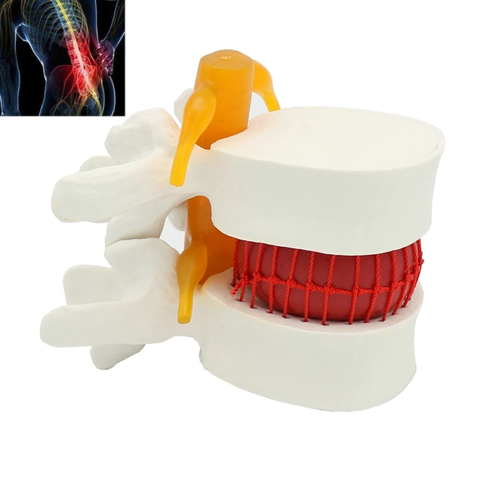 Anatomical Spine Lumbar Disc Herniation Anatomy Medical Teaching Tool ...