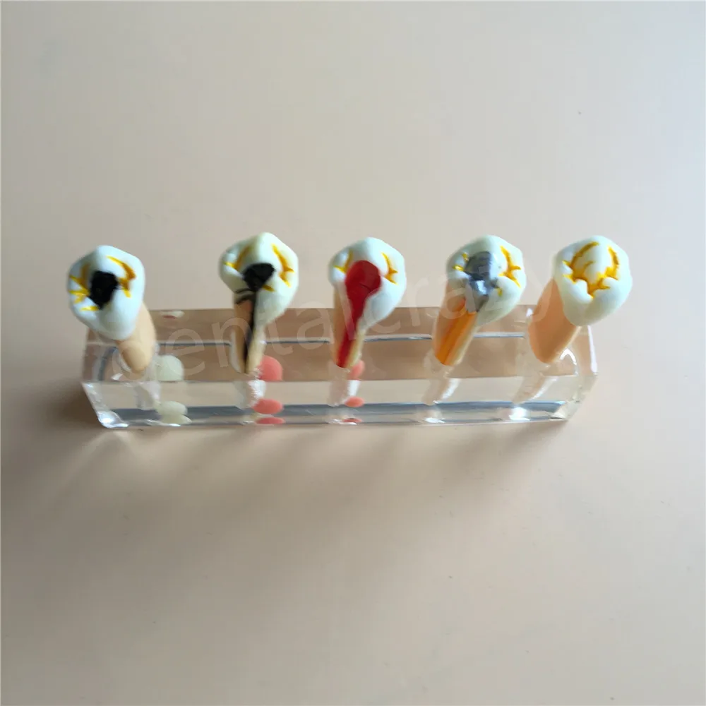 Хит продаж стоматологическая 5 ступенчатая модель эндодонтического лечения