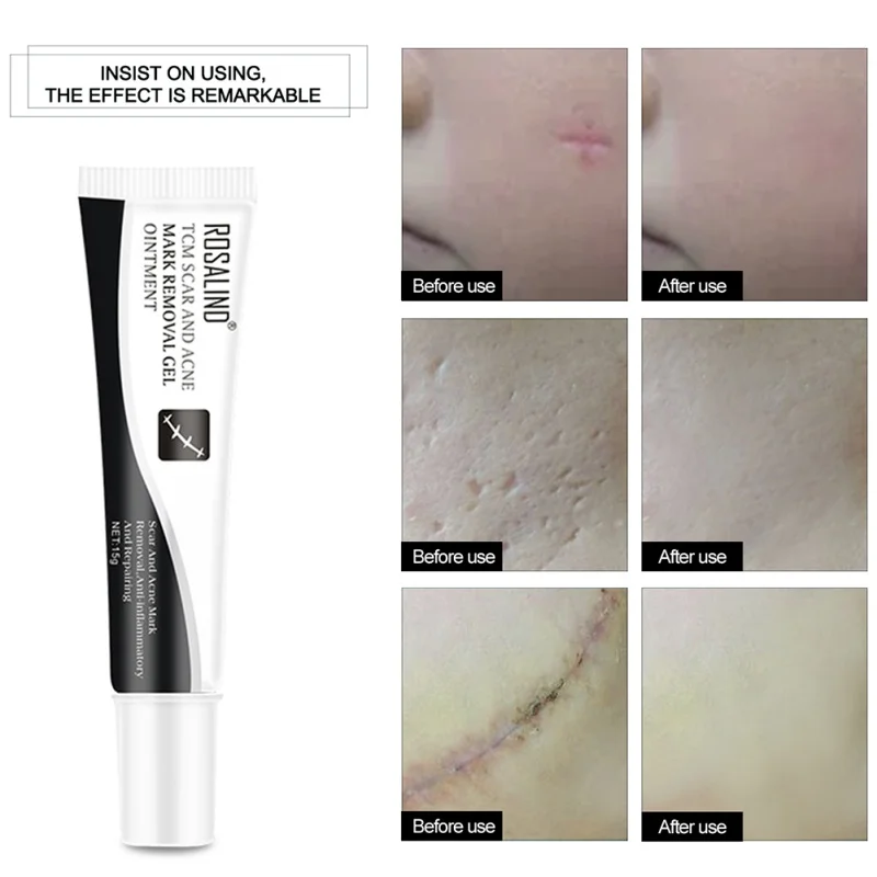 Acne Scar Removal Cream Skin Repair Face Spots Treatment Blackhead Whitening Stretch Marks | Красота и здоровье