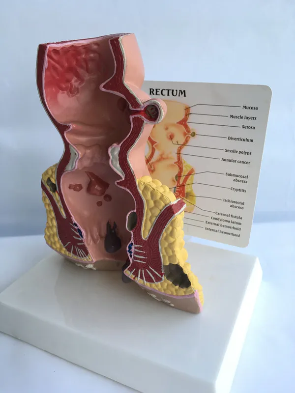 Anatomical model of appendix and cecum Medical teaching Human anorectal pathological | Канцтовары для офиса и дома