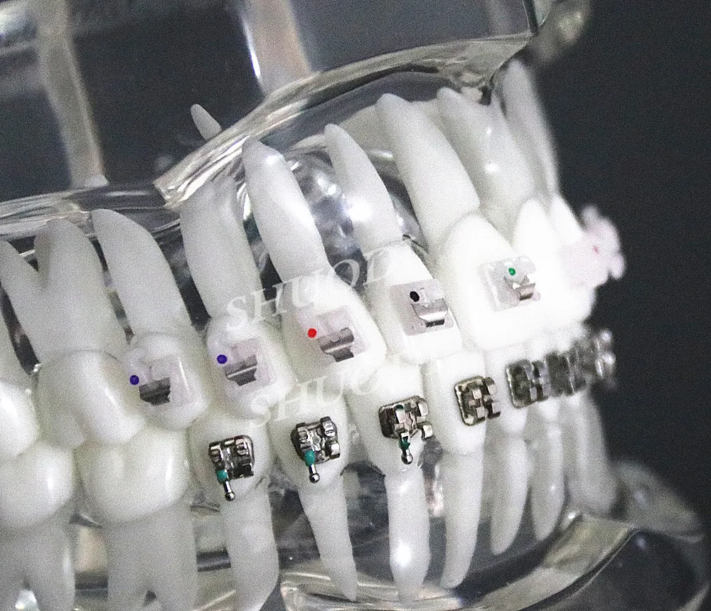 Стоматологическая Ортодонтическая модель для связи с пациентами 4 вида скоб