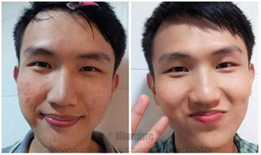 Медицинский крем от акне 20 г для быстрого контроля жирности лечения прыщей