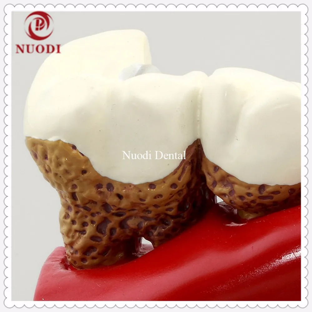 Dental Implant Teeth Model/Dentistry Disassembling Caries dental tooth Model/4times teeth model |