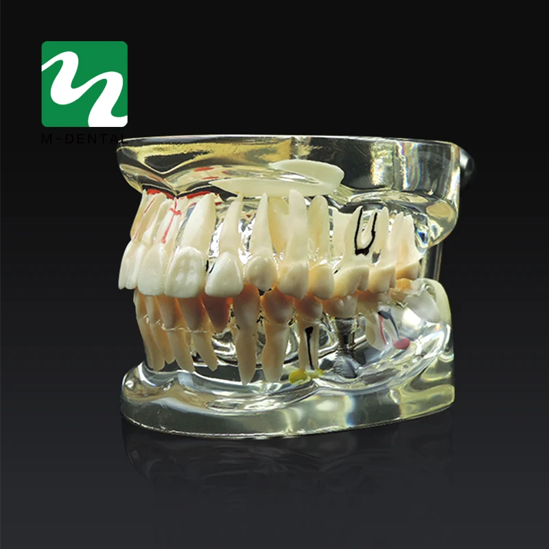 Модель зубов для обучения патологии и заболеваниям взрослых модель съемная