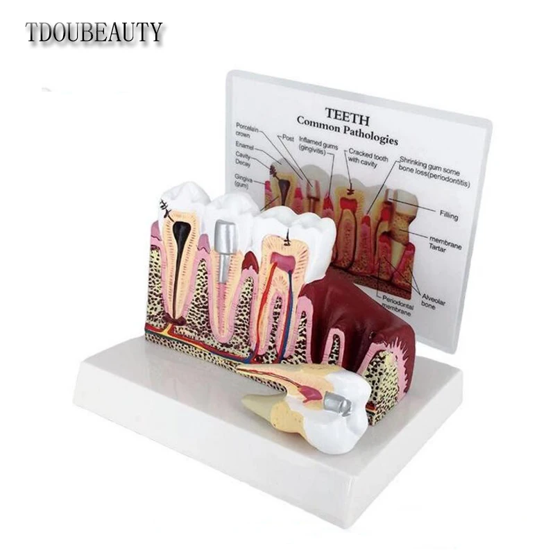 New Dental Pathology Teaching Model, Dental Calculus, Tooth Decay, Gingival Inflammation, Planar Model.Free Shipping