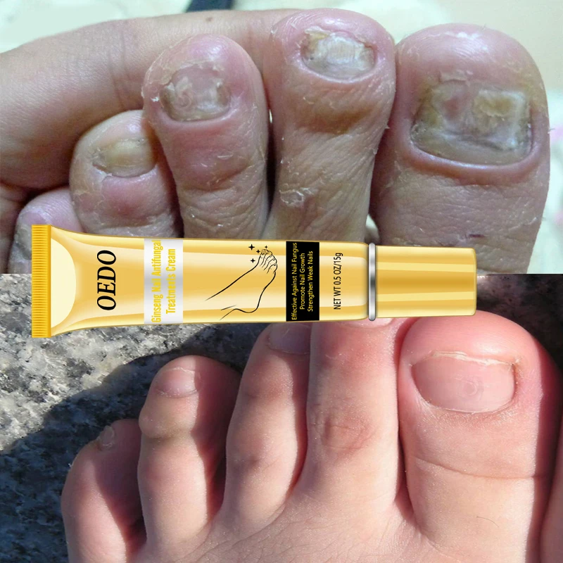 Грибковые ногтей ноги отбеливающий носком гель для удаления анти-инфекция