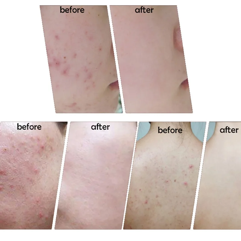 

1pcs Herbal Anti-acne Cream Anti Pimple Spot Acne Scars Blackhead Removal Cream Whitening Beauty Skin Face Care Creams H7