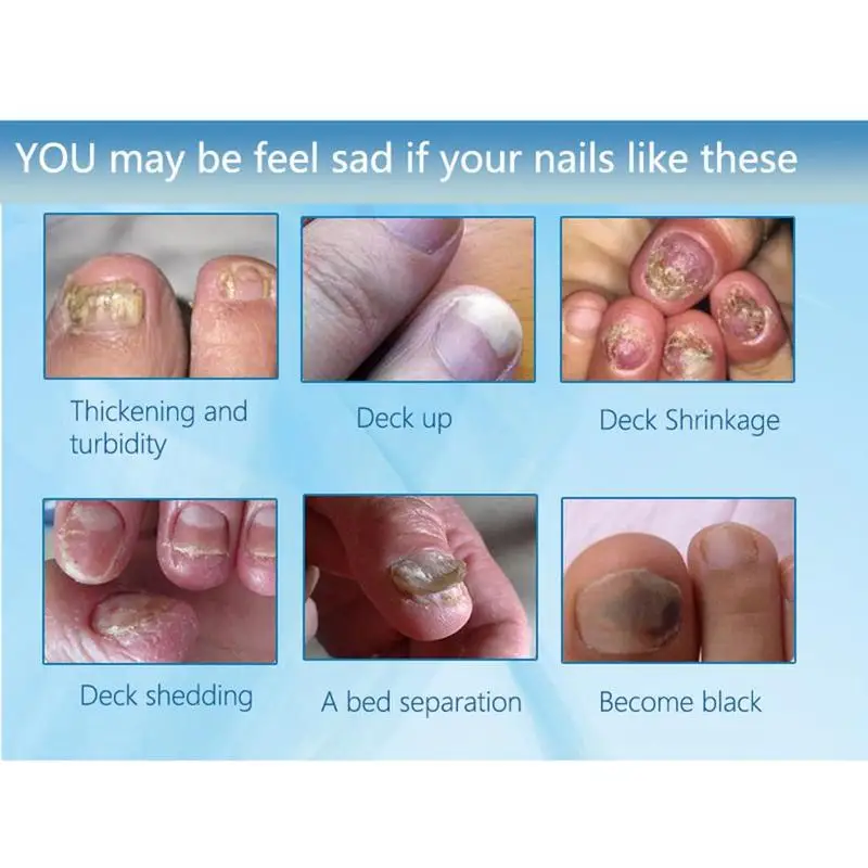 Средство от грибка ногтей Лечение ног Уход за ногами отбеливающая Эссенция