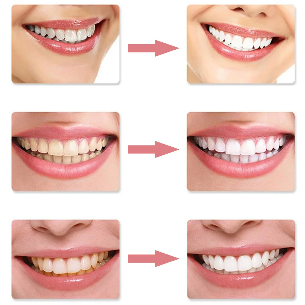 Гель для отбеливания зубов 10 шт. пероксид карбамида гель 3 мл в шприцах красоты |
