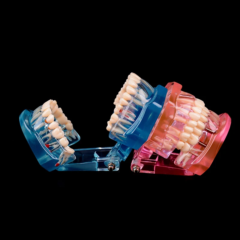 

Hot Dental Implant Disease Teeth Model With Restoration Bridge Tooth Dentist For Medical Science Dental Disease Teaching Study