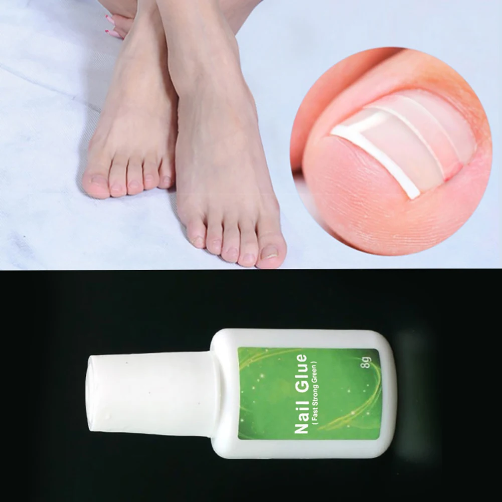 8 г Новый Paronychia клей для ногтей вросший Toenail корректирующий Педикюр Toe патч уход за