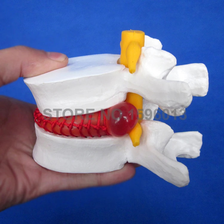 Медицинский Поясничный позвонка модель поражения нормальном состоянии CMAM VERTEBRA12