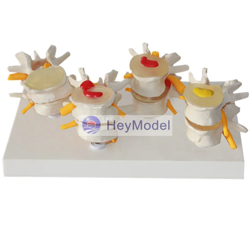 Четырехступенчатая поясничная модель позвоночника HeyModel костные шпоры