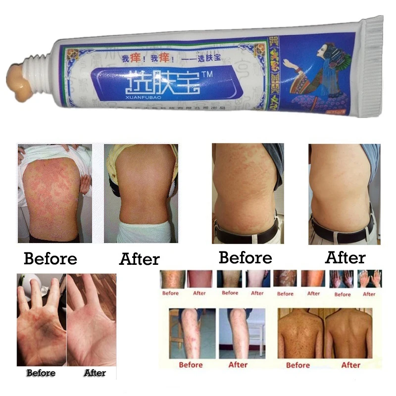 

Natural Herbal Body Cream Skin Psoriasis Cream Dermatitis Itching Repair Eczematoid Ointment Treatment Psoriasis Eczema Itching