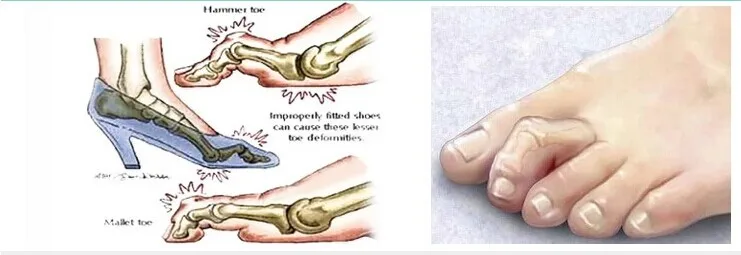 1 пара силиконовый корректор для защиты пальцев ног эктропион средство ухода за