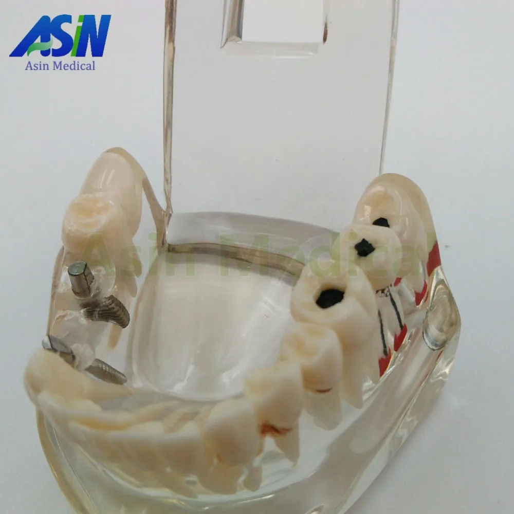 Демонстрационный кронштейн для имплантации зубов модель съемный | Красота и