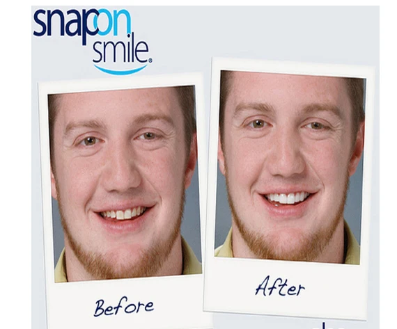 Отбеливающие подтяжки Snapon Smile зубная наклейка | Бытовая техника