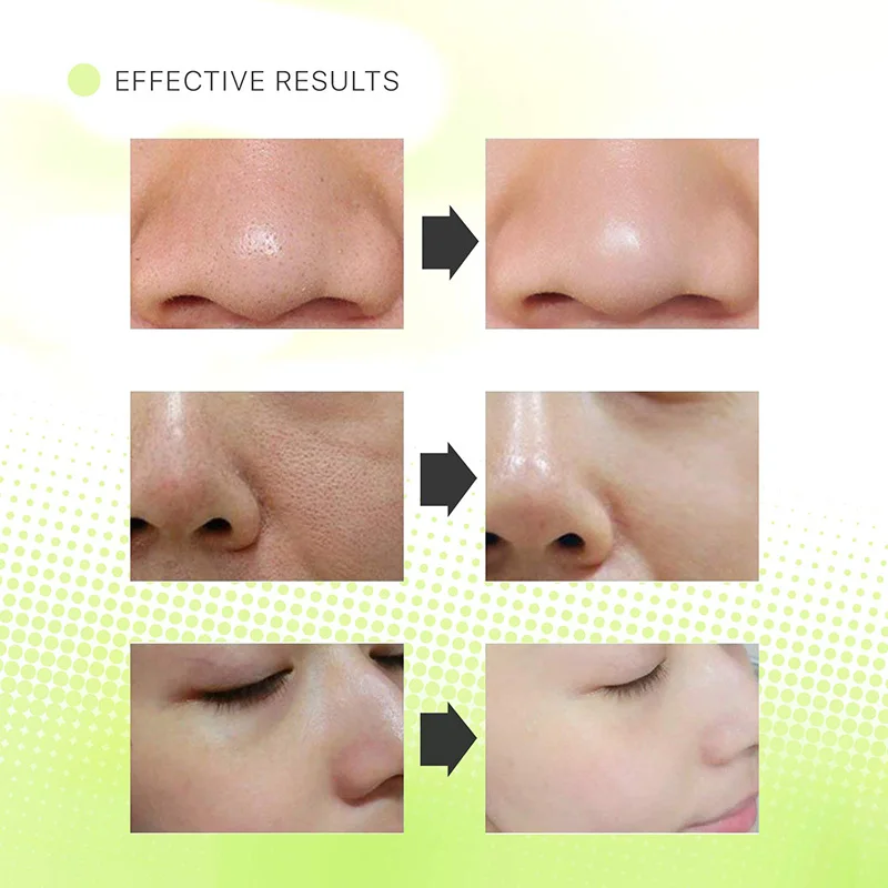 Скребок для кожи с угревой поверхностью и устройство очистки пор отшелушивающий