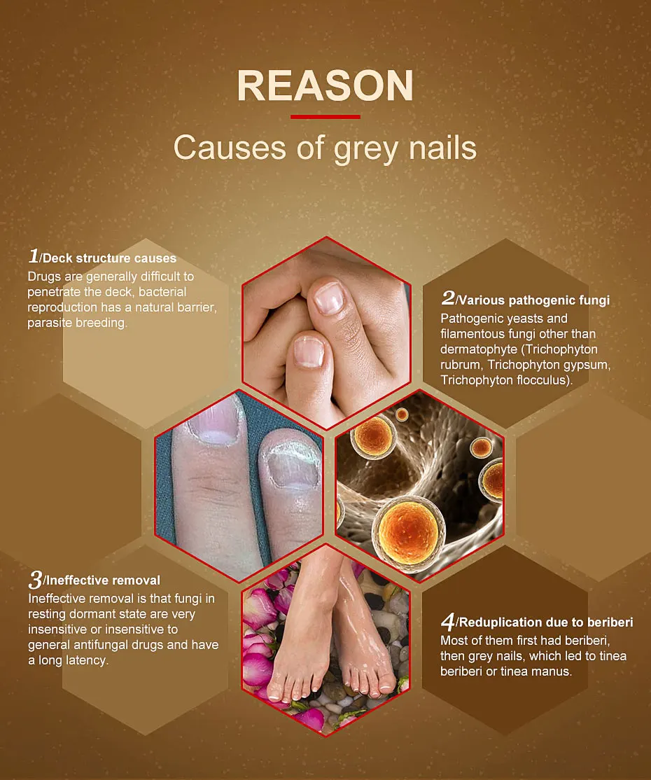 Средство для лечения ногтей от грибков эссенция ухода за ногами отбеливания на