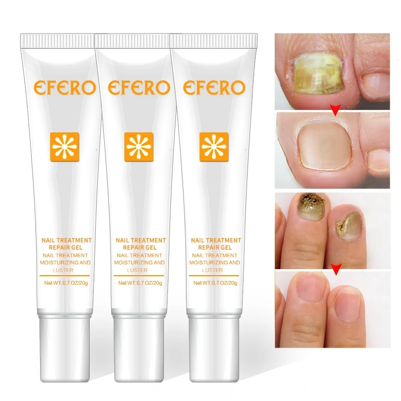 Nail Treatment Repair Gel Growth Product Remove Onychomycosis Broken Treatments | Красота и здоровье
