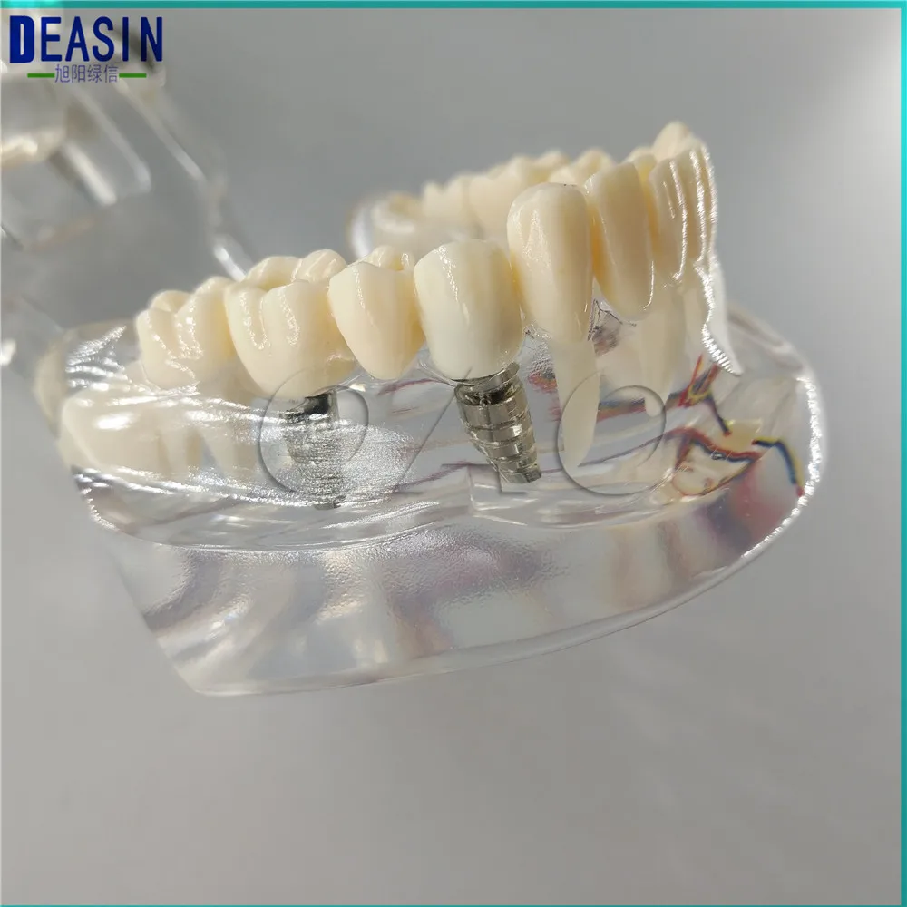 

dental implant teeth model with nerve Transparent pathological Repair model Teaching demonstration model