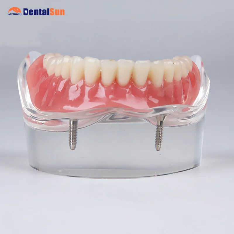 

Dental Demonstration Model/M6002 Overdenture Inferior model with 2 implant