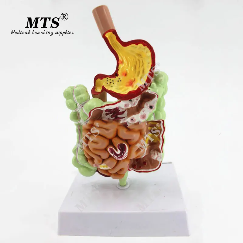 Желудочно кишечная патология человека MTS анатомическая модель пищеварения