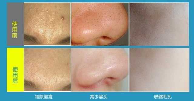 Массажер Электрический массажер для лица угрей палка массажа морщин удаления