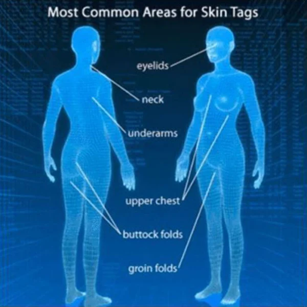 Скин для удаления этикеток медицинский Tu убить бирки кожи моль & женских половых