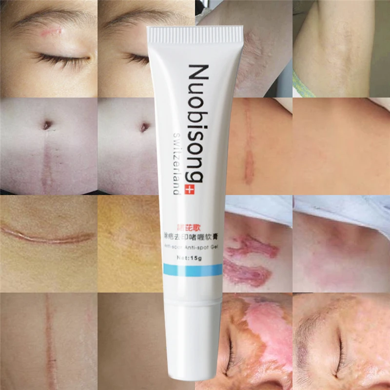 

5Pcs Nuobisong Remove Scar Cream Remove Acne Spots Remove Striae Gravidarum Pigmentation Corrector Anti-Aging Moisturizing Box