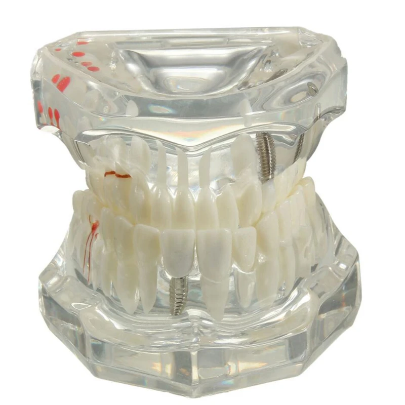 1 шт. модель зубного имплантата демонстрация мостика для восстановления зубов