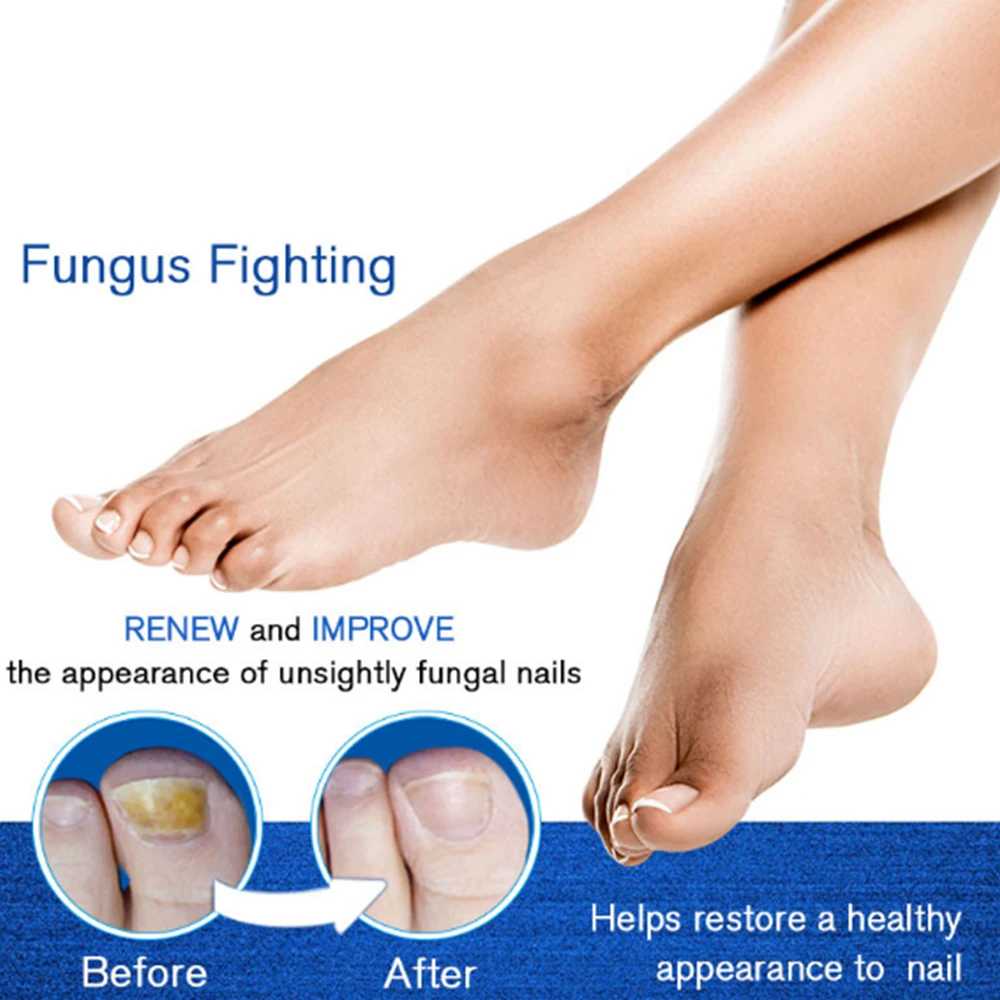 4 мл китайская Ручка для лечения Ногтей онихомикоз пароникья против грибковой