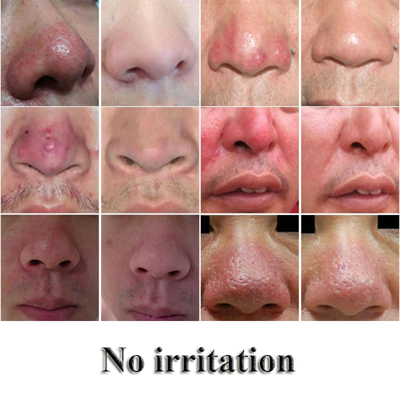 Крем мазь для удаления угрей и акне крем ухода за кожей травяные антиакне клещи