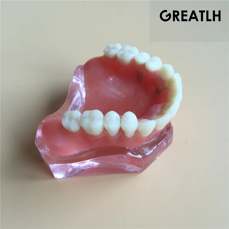 Модель зубного имплантата зубные зубы модель|dental tooth|teeth modeltooth teeth |