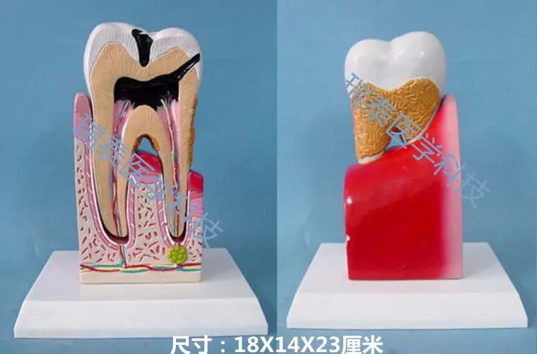 

12*11*20cm Medical Science tooth model pathological teeth Dental caries Tooth decay Oral cavity teaching mould