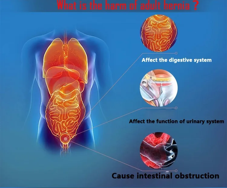 inguinal hernia паховая грыжа поддрержка лечение для взрослый с лекарства пах грыжа лечение взрослых детей inguinal hernia support belt hernia inguinal поддержка грыжи медицинская изделия продукция