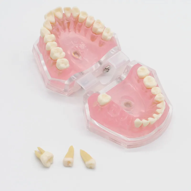 Стоматология лабораторная модель исследования зубов Overdenture Нижняя 4 имплантата