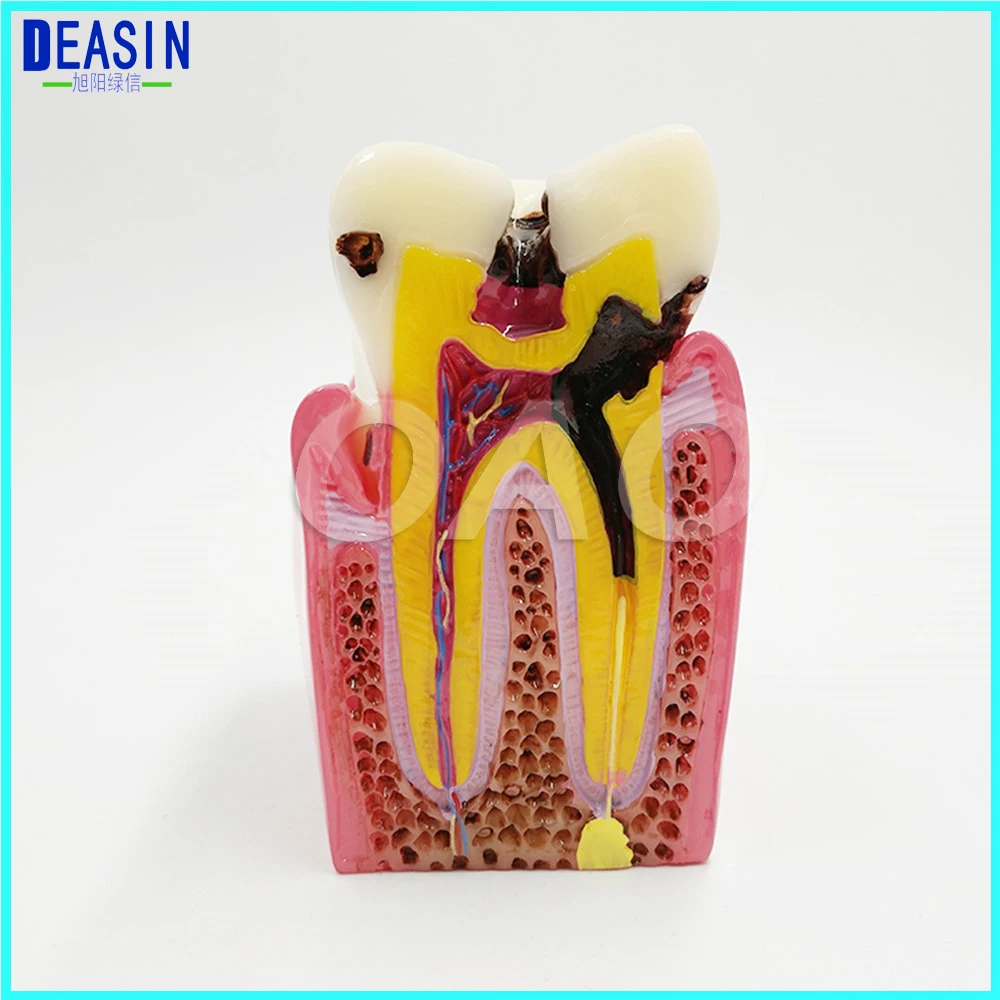 

Denture Teeth model 6X, caries comparison model, tooth decay model,Dentist for Medical Science Teaching
