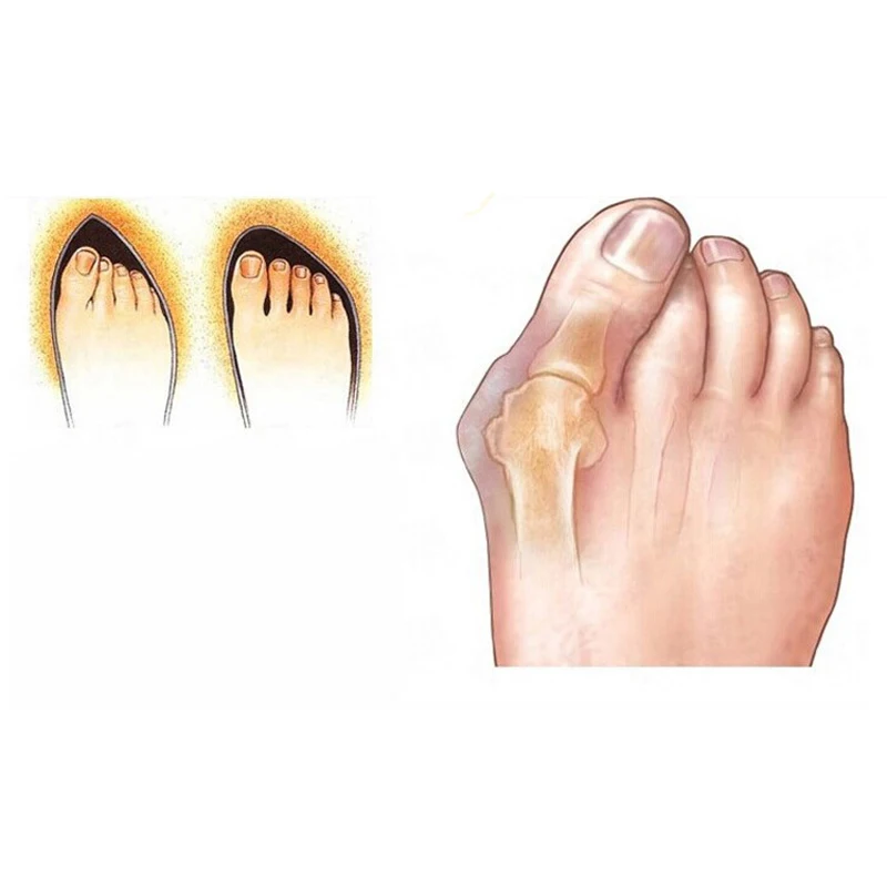 

5 Pairs Foot Care Pedicure Gel Toe Straightener Overlapping Hallux Valgus Protector Finger Toe Separator And Bunion Corrector