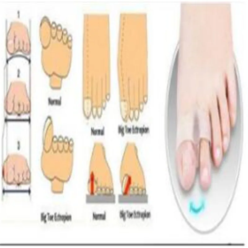 1 шт. 2 отверстия для ног гель ухода за кожей выпрямители пальцев сепаратор