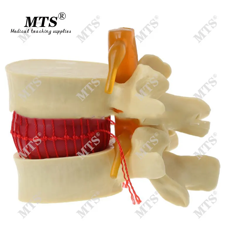 Человеческая планшетологическая герниация обучающая модель медицинский