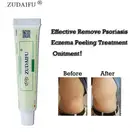 Горячая продажа ZUDAIFU крем для псориаза тела без розничной коробки уход за кожей