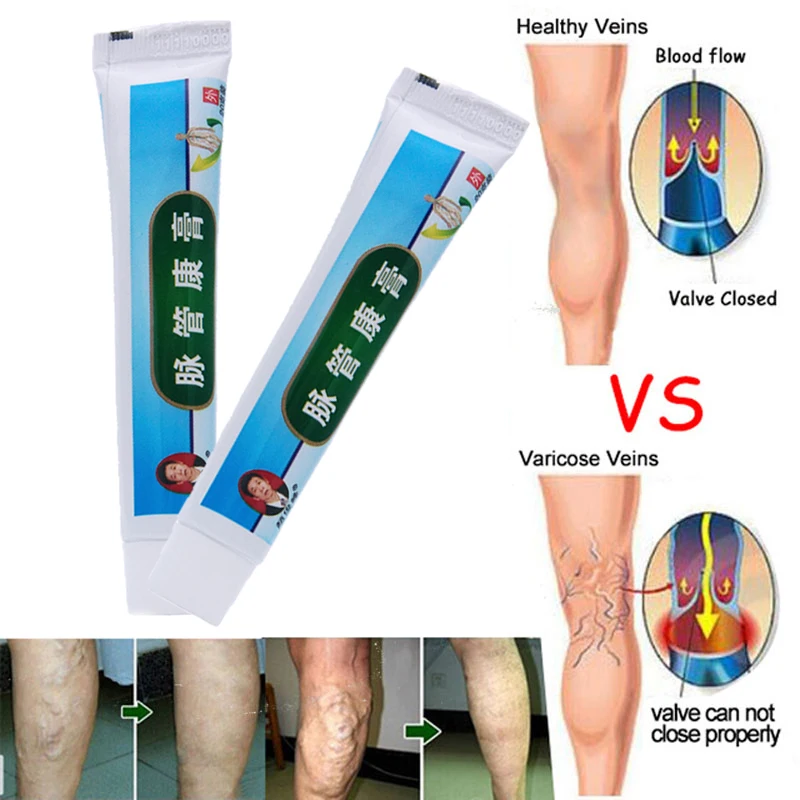 

Китайская натуральная травяная медицина для лечения варикозного расширения сосудов, воспаления, массажный крем для лечения варикозного ра...